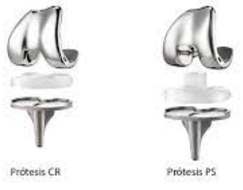 CR = cruciate retaining
PS = posteriorly stabilized